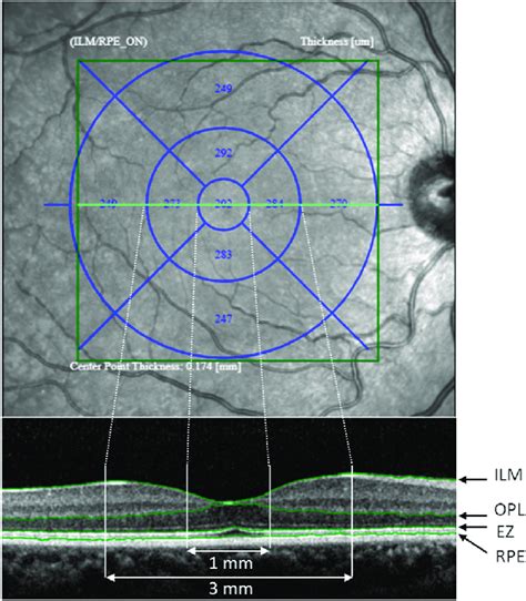 retinal thickness treatment